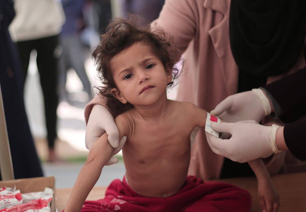 Leen, 2 ans, souffre de malnutrition aiguë sévère. Elle souffre d'une perte de poids et d'une atrophie musculaire drastiques. © UNICEF/UNI519944/