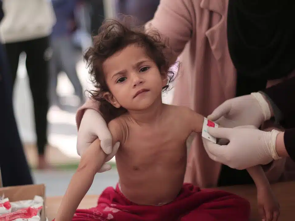 Leen, 2 ans, souffre de malnutrition aiguë sévère. Elle souffre d'une perte de poids et d'une atrophie musculaire drastiques. © UNICEF/UNI519944/
